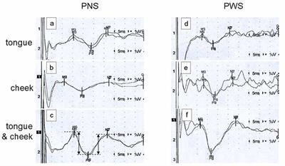 No Evidence for Dystonia-Like Sensory Overflow of Tongue Representations in Adults Who Stutter